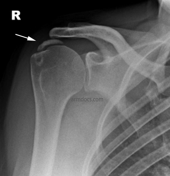 Calcific Tendonitis Arm Docs