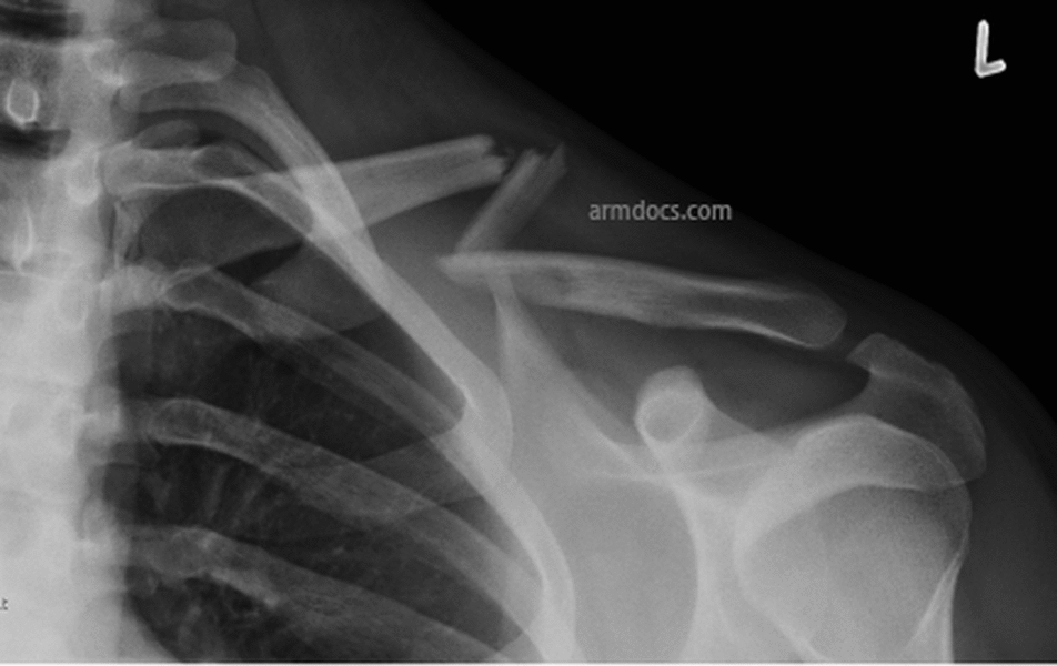 Clavicle Fracture Arm Docs