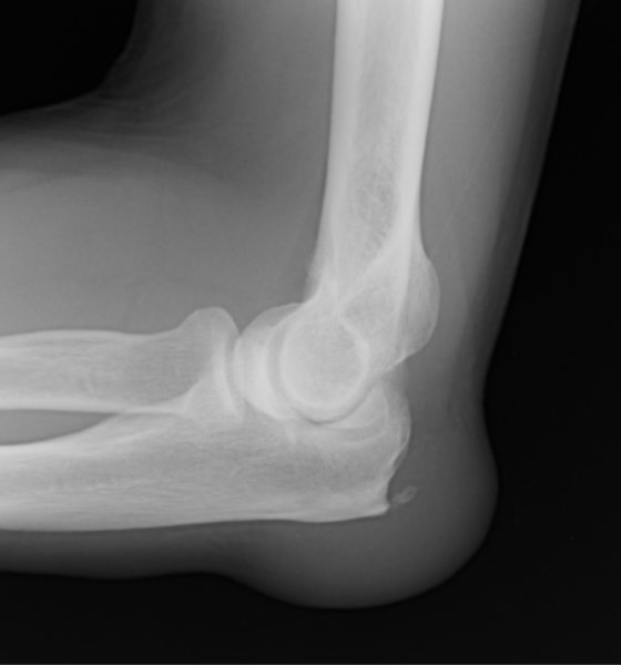 Bursitis of the Elbow Arm Docs