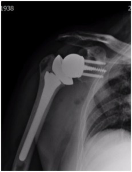 Reverse Shoulder Replacement | Arm Docs