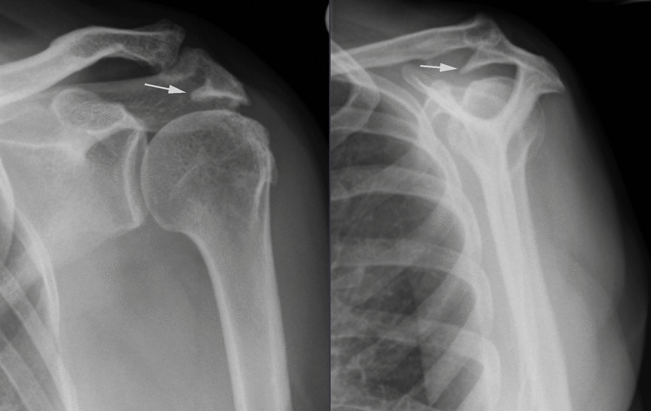 Subacromial shoulder pain Arm Docs