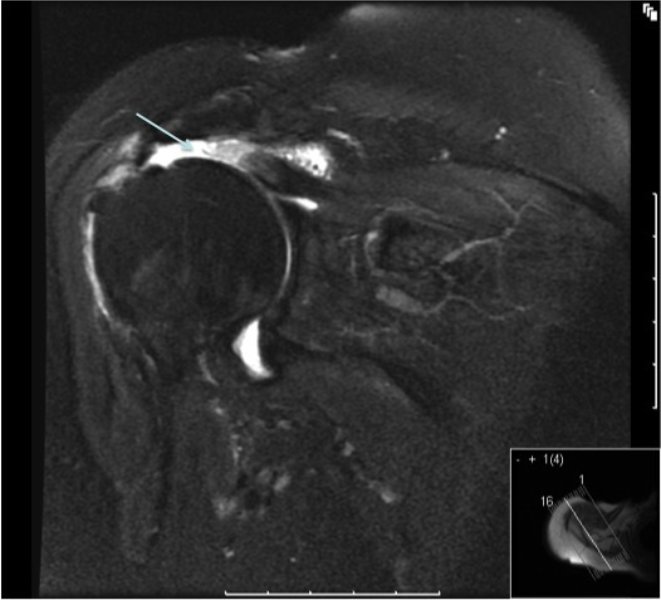 Rotator Cuff Tear Arm Docs