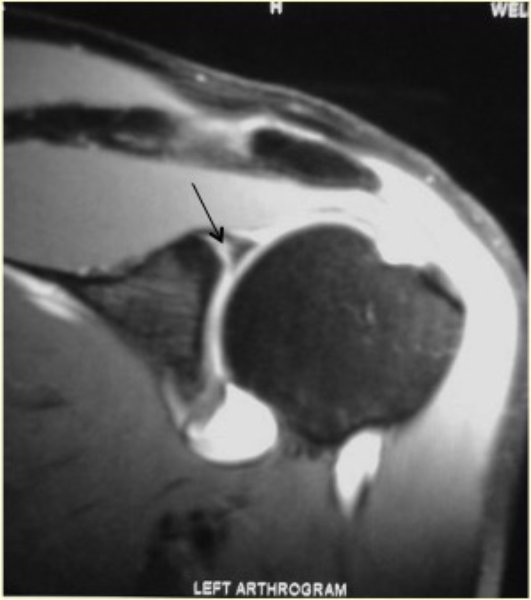 slap tear
