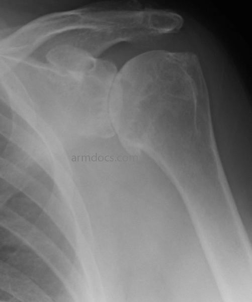 Shoulder Arthritis Arm Docs