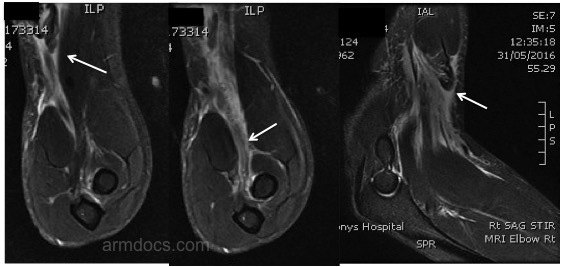 Distal-biceps-MRI-1.jpg#asset:543