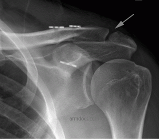 Acj Separation Primary Repair