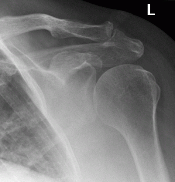 Acromioclavicular Joint Oa