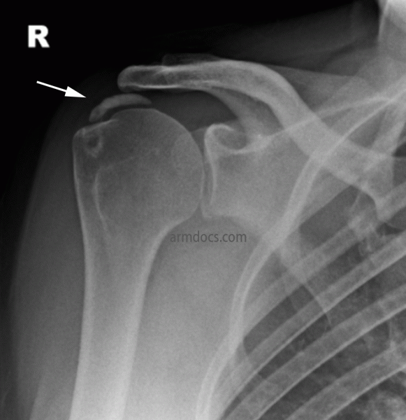 Calcific Tendonitis