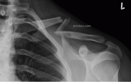 Clavicle Fracture 1A