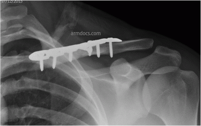 Clavicle Fracture 1B
