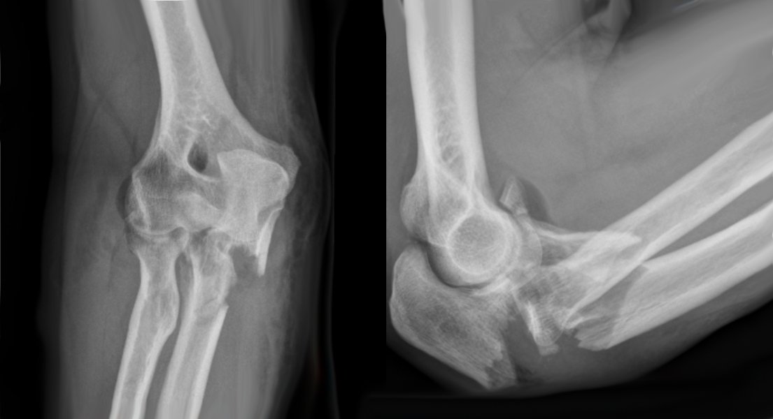 Complex Elbow Fracture 1