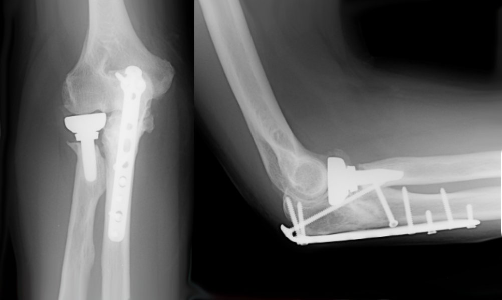 Complex Elbow Fracture 2