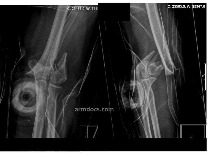Distal humerus fracture