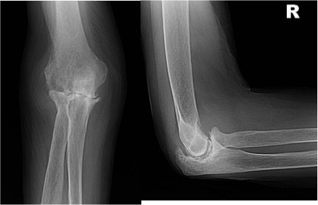 Elbow Arthritis 1