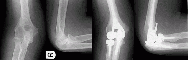 Elbow Replacement