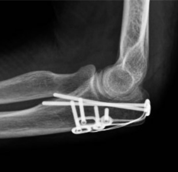 Olecranon Fracture Postop