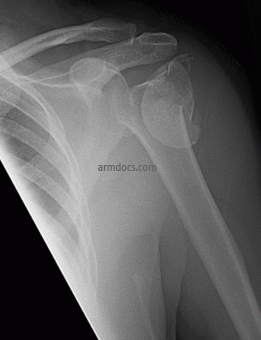fracture of the proximal humerus in a 60 year old lady