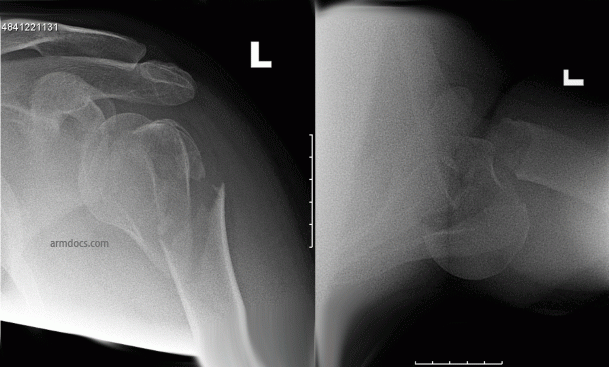 Proximal Humerus Fracture 2A