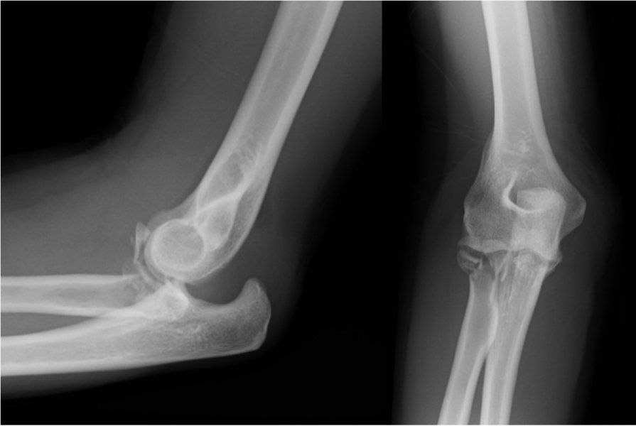 Radial Head Fracture With Dislocation