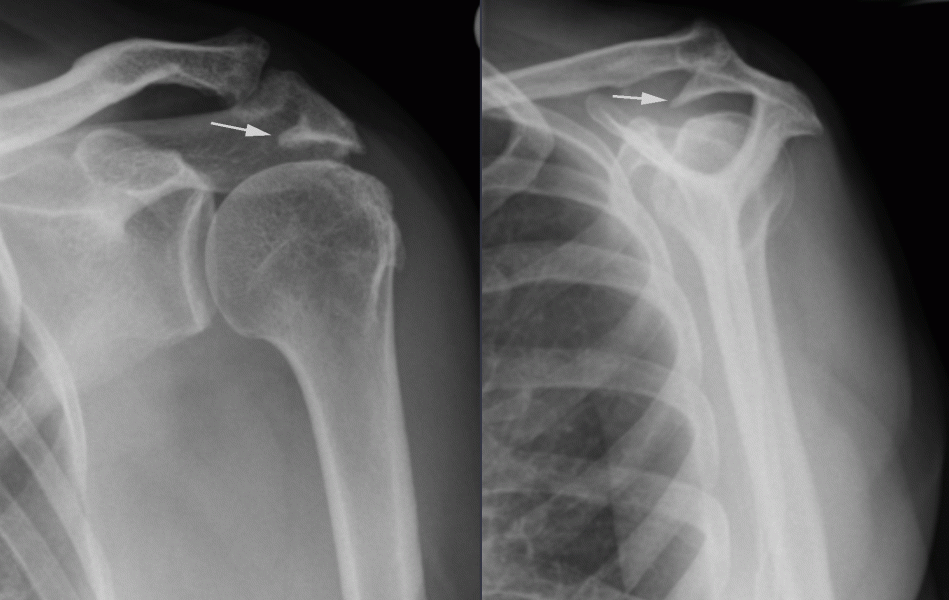 Rotator Cuff Impingement