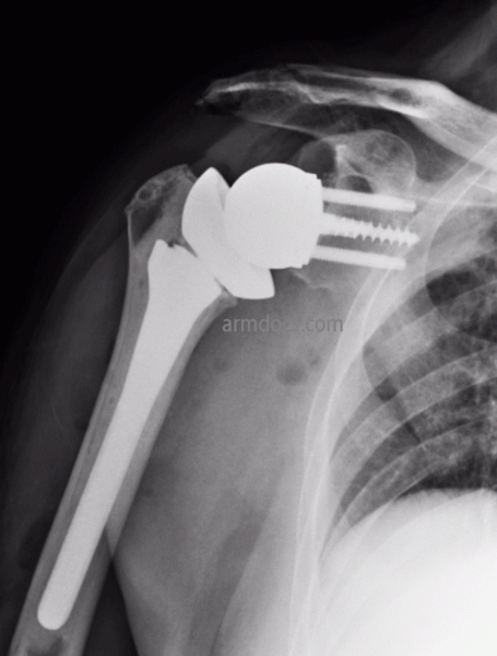 Rotator Cuff Tear Arthropathy Reverse Shoulder Replacement