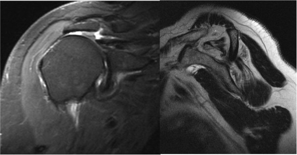 Rotator Cuff Tear