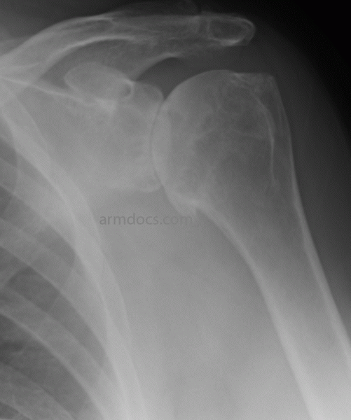 Shoulder Arthritis 1