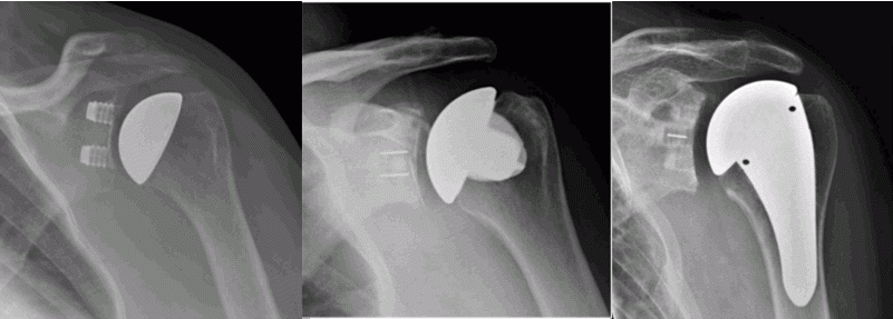 Shoulder Arthroplasty Featured