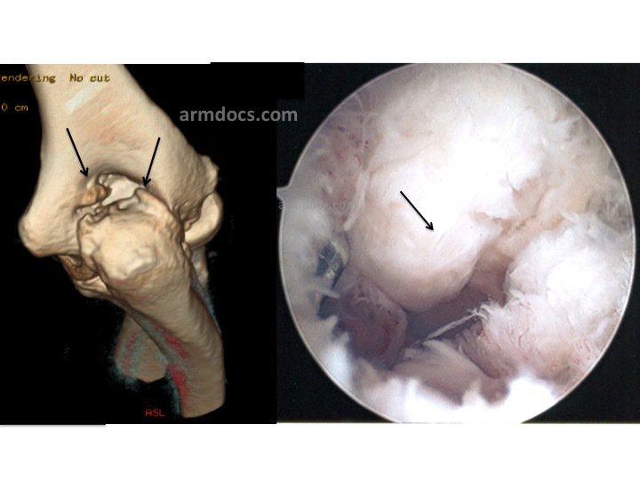 Bone spurs of elbow condition